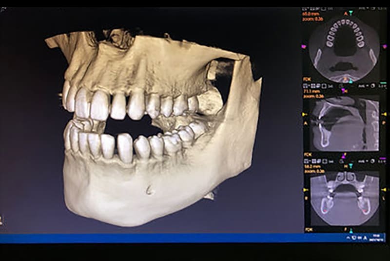 歯科用CT3次元写真