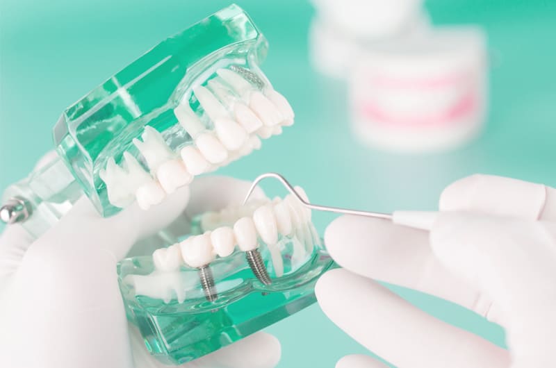 インプラント治療のイメージ